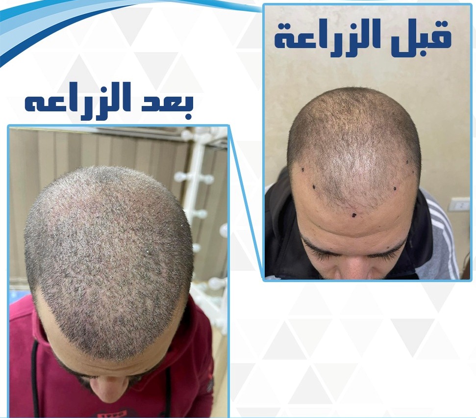 hair transplant